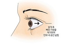 韩国突眼矫正医院可以改善眼球突出的问题,近视突眼有救了!
