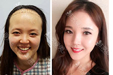 植发后掉发是手术失败了吗？韩国植发效果受哪些因素影响?