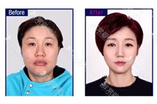 韩国面部轮廓手术怎么样？菲斯莱茵官网真人日记分享！
