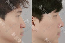 隆鼻后假体会晃动或倾斜吗?韩国隆鼻手术有名医院有哪些?