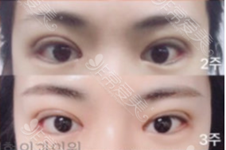 韩国双眼皮手术多久恢复自然?纯真医院双眼皮整形创伤大吗?