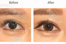 开眼角后为什么会出现疤痕增生？怎么预防疤痕增生？