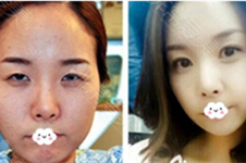 双眼皮修复毁的更严重了！韩国眼部7层缝合哪位医生可以做
