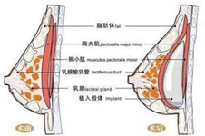 法國伊思雅假體怎么樣？安全嗎有哪些優(yōu)點分幾個系列？