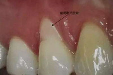 牙龈萎缩怎么办、可以恢复吗？怎么治疗比较好？