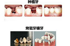 60岁做种植牙好还是镶牙好?分享种植牙和镶牙的区别!