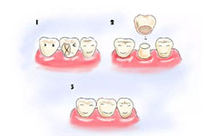 在貴陽(yáng)正規(guī)醫(yī)院補(bǔ)牙如何收費(fèi)?價(jià)格高費(fèi)用貴是真的嗎?