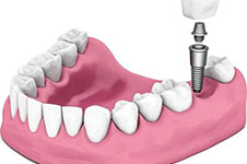 在三門峽種植牙的價(jià)格是多少?缺牙20年了還能做種植牙嗎?