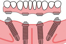 在惠州全口種植牙的價(jià)格是多少?公布滿口牙種植費(fèi)用詳情!