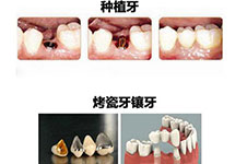 牙齿掉了咋办选择镶牙还是种植牙?植牙与镶牙的区别在哪里