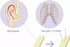 做鼻子耳软骨好还是肋骨好?山根低适合做哪种隆鼻方式?