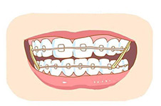 大连矫正牙齿的费用是多少?牙齿矫正大概要花费多少钱?