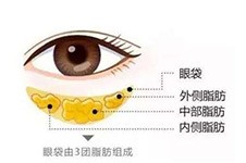 眼袋祛除都有哪些好的方法?祛眼袋泪沟哪种技术会比较好?