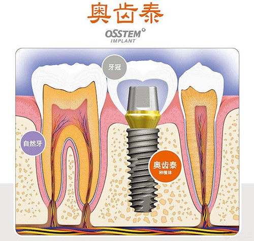 重庆进口种植牙的价格是多少钱?韩国和瑞士种植体均在内!