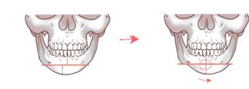 迷你vline手術(shù)是什么?和vline手術(shù)一樣嗎?有什么區(qū)別嗎?