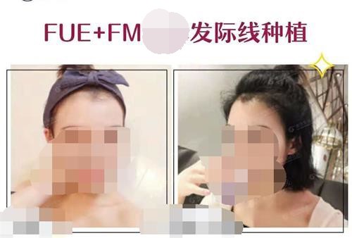 谁知道南京正规的植发医院有哪些?求推荐治疗脱发技术好的