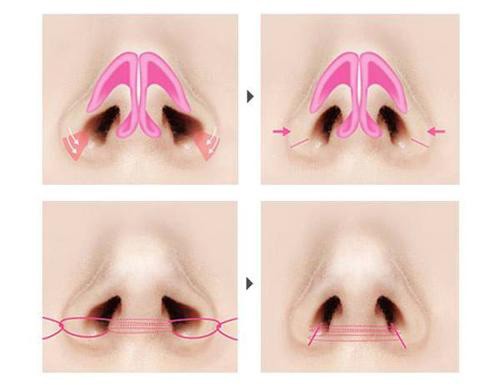 鼻翼縮小是外切好還是內切好?詳解縮鼻翼兩種方式及區(qū)別