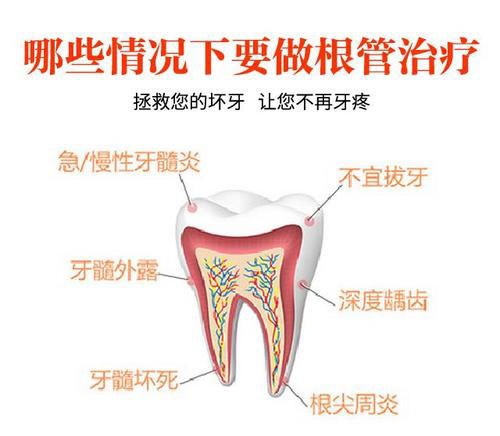 根管治疗就是骗局?是谣言还是真的这里告诉你