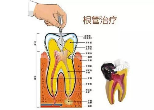 一个牙医的良心忠告根尖炎必看 别不信不然后悔可来不及