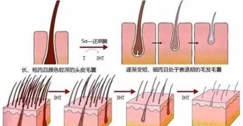 植發(fā)后為什么要平躺?可以側(cè)躺睡覺嗎?平躺我真心睡不著