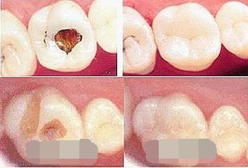 被黑心牙医毁了5颗牙齿!惨痛经历分享去看牙医要避开的坑