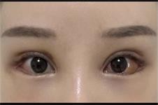 韩国迪美整形医院眼部手术实记，修复手术+矫正+眼角真nice
