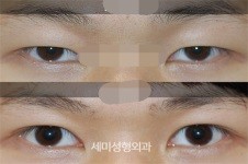 曝韩国世美整形医院青少年眼整形实例，矫正眼睛更有力量