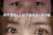 郑州美莱整形张芳做眼睛怎么样?多图探究风格和技术!