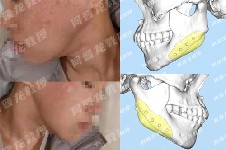上海何晋龙颧骨下颌角怎么样?多图分析其手术风格及特色!