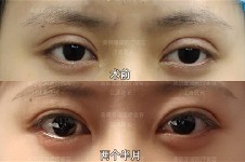 成都江涛医生做双眼皮修复好吗?我做宽变窄感觉不错!