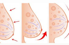 長沙哪里能做胸部下垂矯正?乳房懸吊手術(shù)能保持幾年?