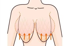 胸部下垂矫正手术风险大吗?常德胸部下垂矫正哪里做的好?