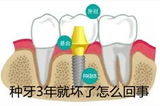 牙友投稿:种牙3年就坏了怎么办?种植牙坏了还能再种吗?