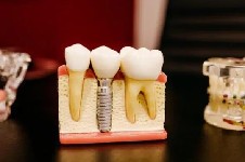 分享我在长沙种植牙亲身经历 说说长沙私人种植牙医院哪好