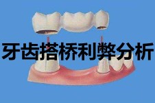 牙齿搭桥会损坏好牙吗?看完牙齿搭桥利弊分析你什么都明白!