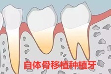 种植牙自体骨移植的优缺点有哪些?有什么后遗症和并发症?