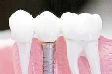 种植牙二期基台被牙肉覆盖正常吗?这样会影响种牙成功率吗?