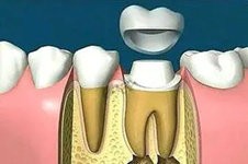長(zhǎng)沙根管治療加牙冠多少錢(qián)一顆?做一顆牙冠能保幾年?