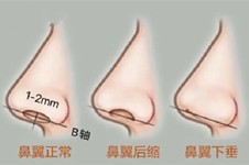 揭秘:常德隆鼻哪里好?順便公開常德假體隆鼻費(fèi)用給你!