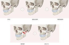 韩国VG百利酷整形颧骨缩小怎么样?手术具体特色分享