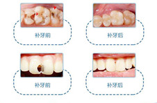 3m树脂补牙是持久吗？补牙用什么材料好？多少钱？