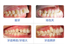 成年后牙齿矫正会有副作用吗？牙齿矫正后会松动、掉牙吗?