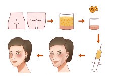 自体脂肪填充后忌讳这6件事,还有做脂肪填充佳年龄必知