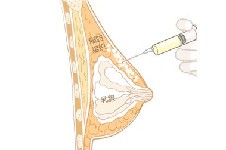 自体脂肪填胸需要多少脂肪?每侧胸注射脂肪300~400ml因人而异