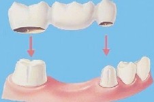 牙齿搭桥要去几次?良心牙医建议缺牙修复这样补,耐用不伤牙