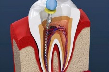 牙特疼,大家要扛住尽量不要做根管治疗!一个牙医的良心忠告