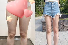 我在韩国365mc医院大腿抽脂后瘦了28斤!韩国当地人都认他们家