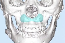 3d打印鼻基底是什么材料?武汉鼻基底填充好的医院医生名单