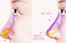 怎么才能把鼻子变挺起来?隆鼻手术就不错有3大隆鼻方式可选