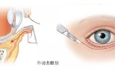 武汉五洲整形去眼袋功效如何?外切+内切对症祛除顽固型眼袋